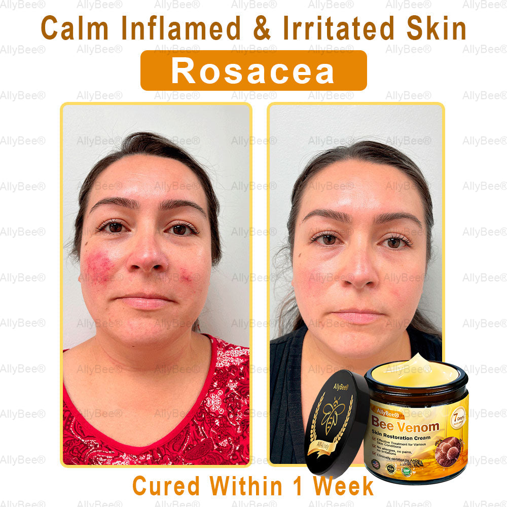 【Official Shop】 AllyBee® Skin Treatment Cream Anti-aging, Hydrating, Skin Repair, Even Tone, Acne and Dark Spot Treatment, Wart and Mole Removal, Psoriasis Relief