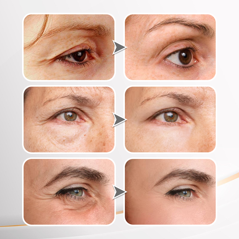 🔥 Last Day Discount: 88% OFF💐Instant Wrinkle Eye Tightener cream