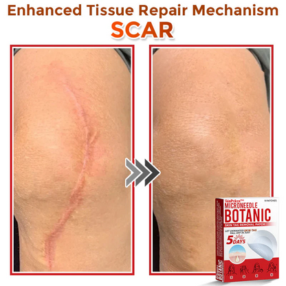 🌈SkinPrikyn™ MicroNeedle Botanic Skin Tag Removal Patch 🇺🇸 Made in the USA