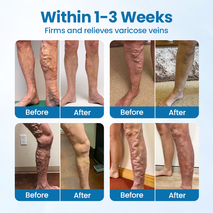 ODEIUN® VeinGuard Herbal Spray-✅ Clinically proven to eliminate varicose veins in just 7 days!