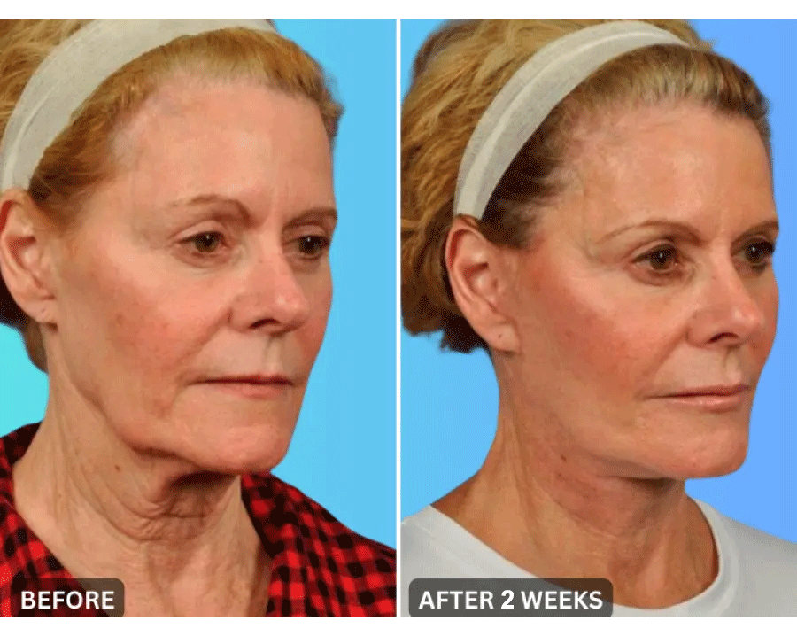 🔥Last Day 79% Off JEREMYTIS™ Skin Firming Beauty Meter