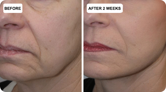 🔥Last Day 79% Off JEREMYTIS™ Skin Firming Beauty Meter