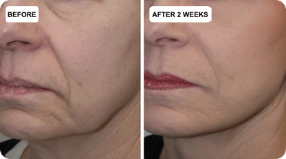 🔥Last Day 79% Off JEREMYTIS™ Skin Firming Beauty Meter