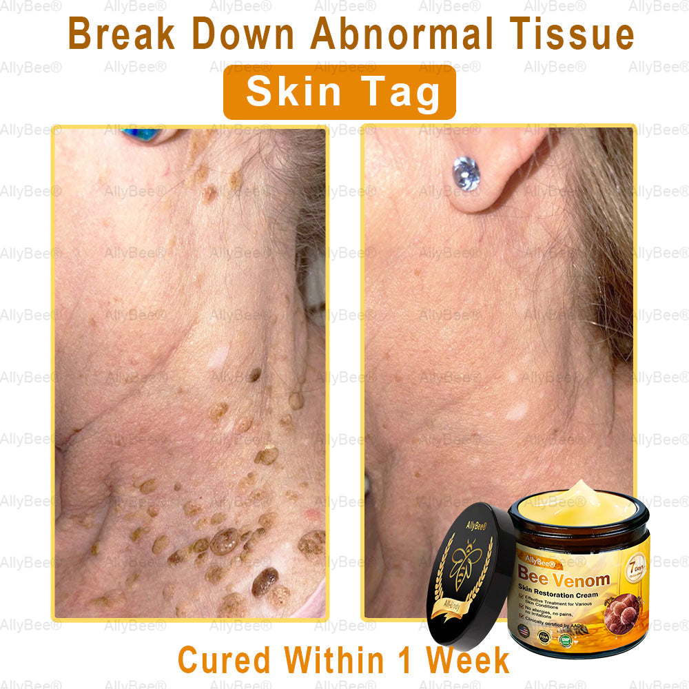 【Official Shop】 AllyBee® Skin Treatment Cream Anti-aging, Hydrating, Skin Repair, Even Tone, Acne and Dark Spot Treatment, Wart and Mole Removal, Psoriasis Relief