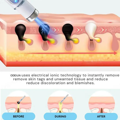 🔥【OFFICIAL STORE】ODEIUN™ Non-Invasive Mole and Wart Removal Laser Pen