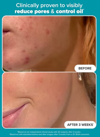 🔥LAST DAY 49% OFF✨ODEIUN™- Skin Perfecting 2% BHA Liquid Exfoliant