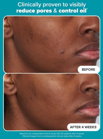 🔥LAST DAY 49% OFF✨ODEIUN™- Skin Perfecting 2% BHA Liquid Exfoliant