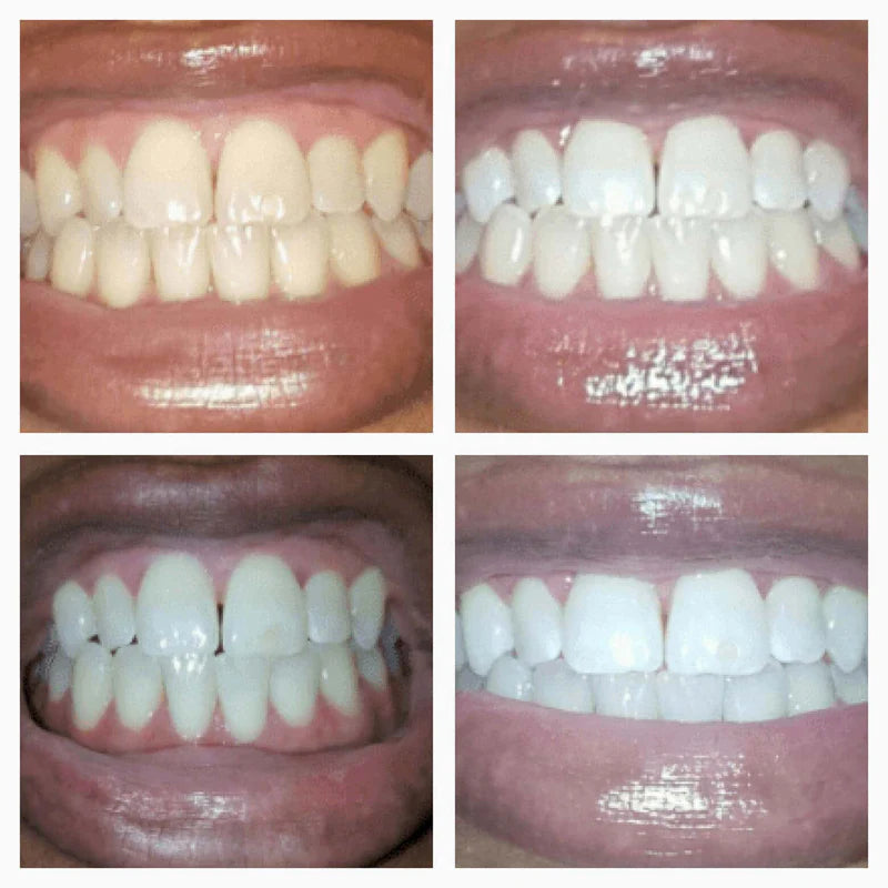 Whitening Pen for Stain Removal & Whiter Teeth