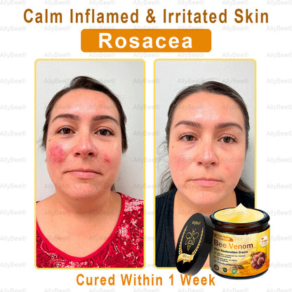 【Official Shop】 AllyBee® Skin Treatment Cream Anti-aging, Hydrating, Skin Repair, Even Tone, Acne and Dark Spot Treatment, Wart and Mole Removal, Psoriasis Relief