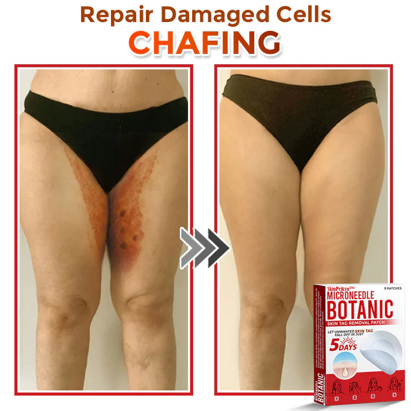🌈SkinPrikyn™ MicroNeedle Botanic Skin Tag Removal Patch 🇺🇸 Made in the USA