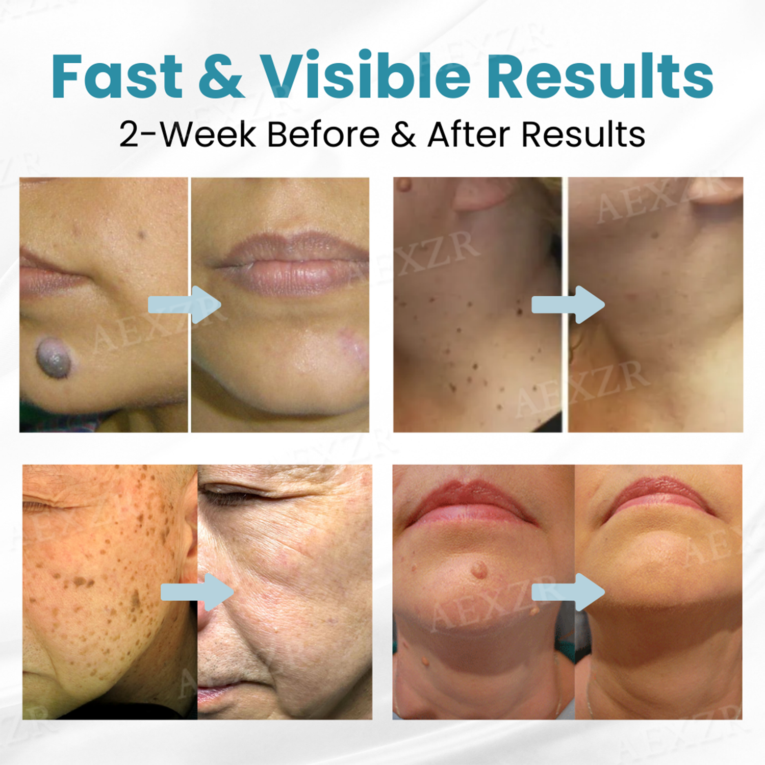 JEREMYTIS® Non-Invasive Mole and Wart Removal Laser Pen