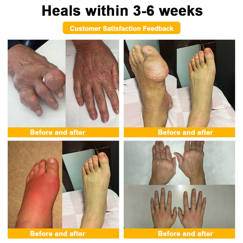 🎁Flash Sale - ODALIT™ Botulinum Toxin & Bee Venom Pain-Relief Bone Healing Cream