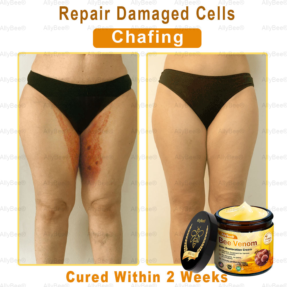 【Official Shop】 AllyBee® Skin Treatment Cream Anti-aging, Hydrating, Skin Repair, Even Tone, Acne and Dark Spot Treatment, Wart and Mole Removal, Psoriasis Relief