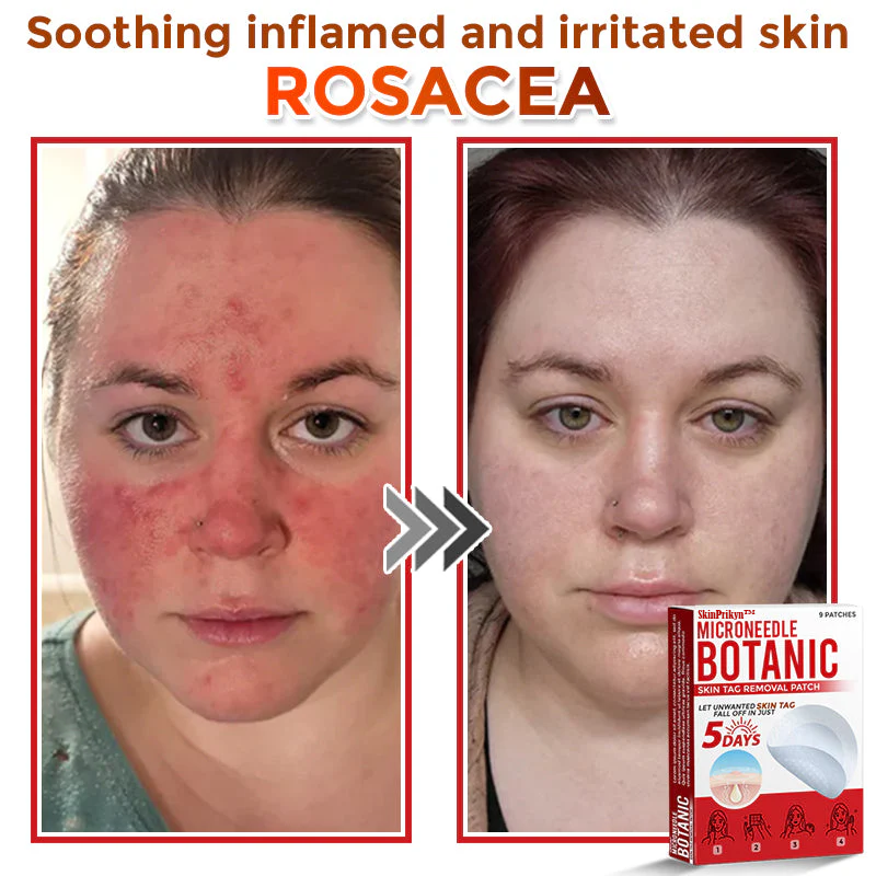 🌈SkinPrikyn™ MicroNeedle Botanic Skin Tag Removal Patch 🇺🇸 Made in the USA