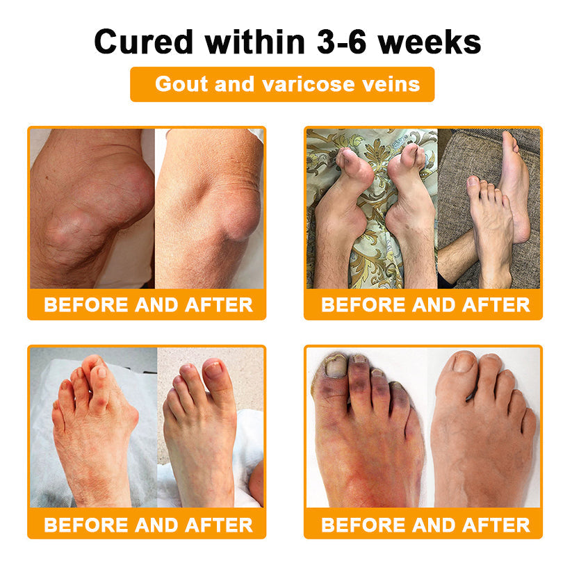 🎁Flash Sale - ODALIT™ Botulinum Toxin & Bee Venom Pain-Relief Bone Healing Cream