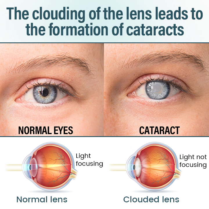 🔥Timilk® OptiFusion Nano Eye Drops Serum —Nano Technology Restores Clear Vision,  No Glasses, No Surgery