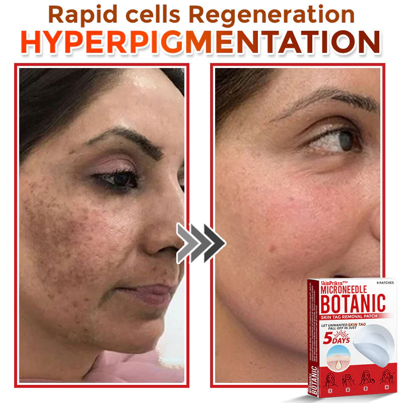 🌈SkinPrikyn™ MicroNeedle Botanic Skin Tag Removal Patch 🇺🇸 Made in the USA