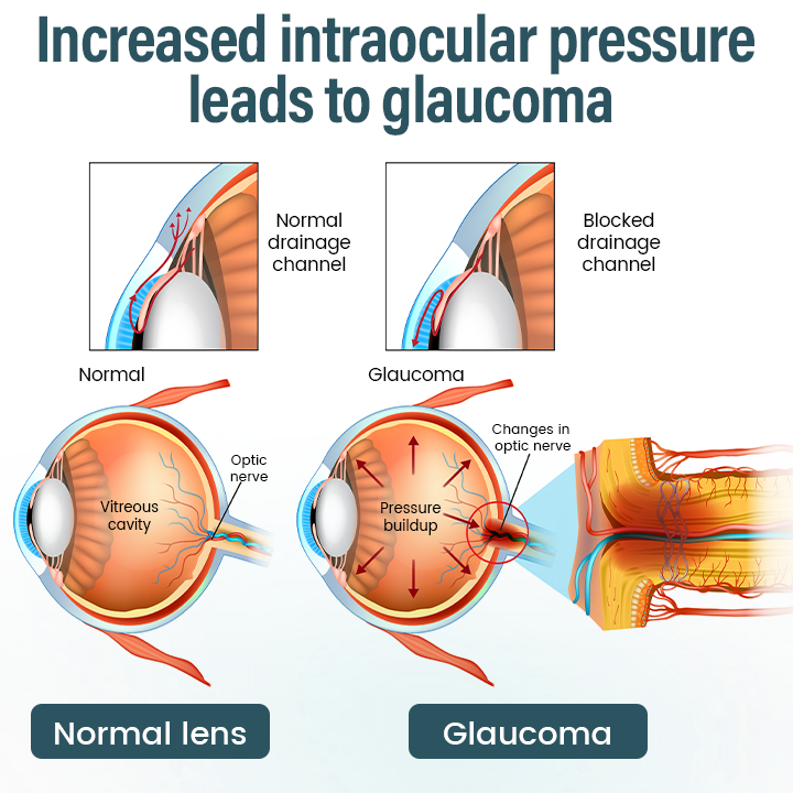 🔥Timilk® OptiFusion Nano Eye Drops Serum —Nano Technology Restores Clear Vision,  No Glasses, No Surgery