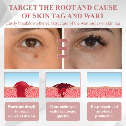 ODEIUN® Wart & Spot Removal Peel-Off Gel Wrapping Mask