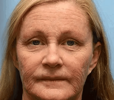 【Official Shop】 AllyBee® Skin Treatment Cream Anti-aging, Hydrating, Skin Repair, Even Tone, Acne and Dark Spot Treatment, Wart and Mole Removal, Psoriasis Relief