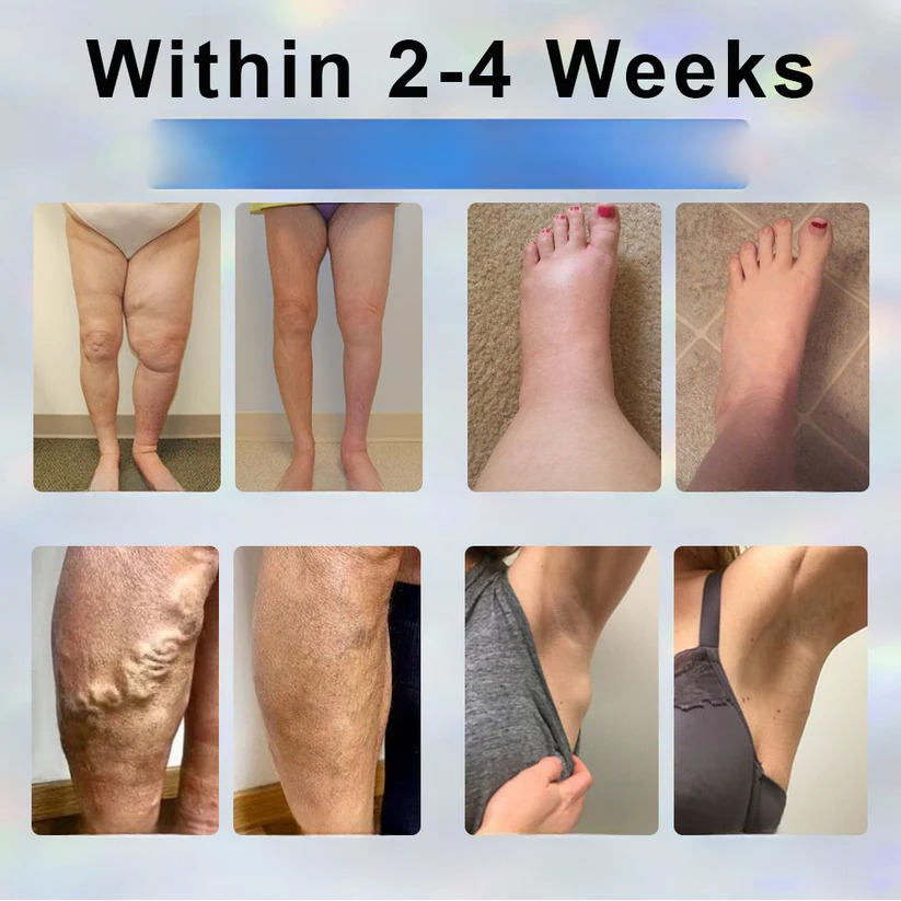 ODEIUN® Black Cumin Edema Detox Herbal Cream