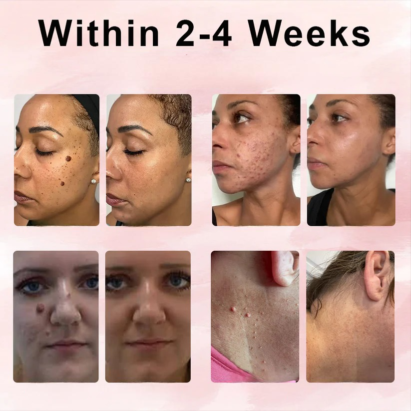 ODEIUN® Wart & Spot Removal Peel-Off Gel Wrapping Mask