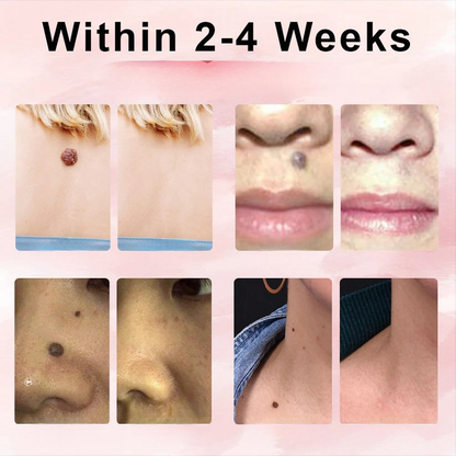 ODEIUN® Wart & Spot Removal Peel-Off Gel Wrapping Mask