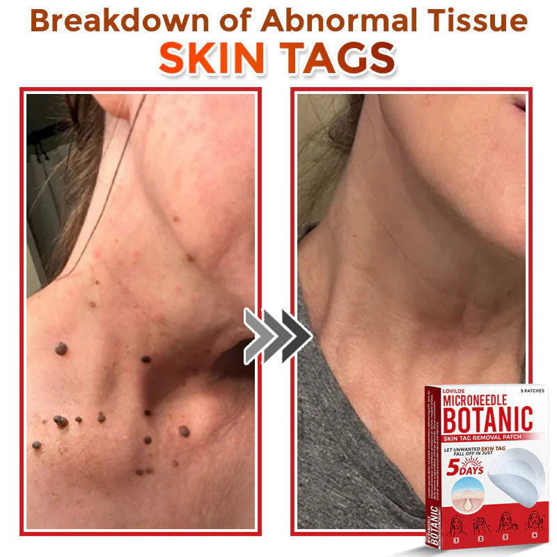 🌈LOVILDS® MicroNeedle Botanic Skin Tag Removal Patch (Made in the USA)