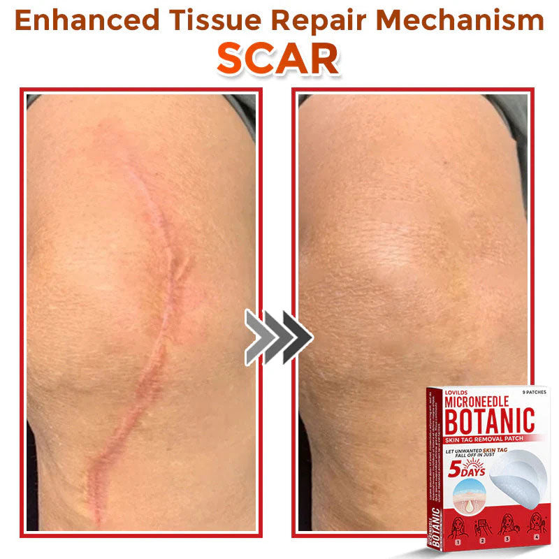 🌈LOVILDS® MicroNeedle Botanic Skin Tag Removal Patch (Made in the USA)