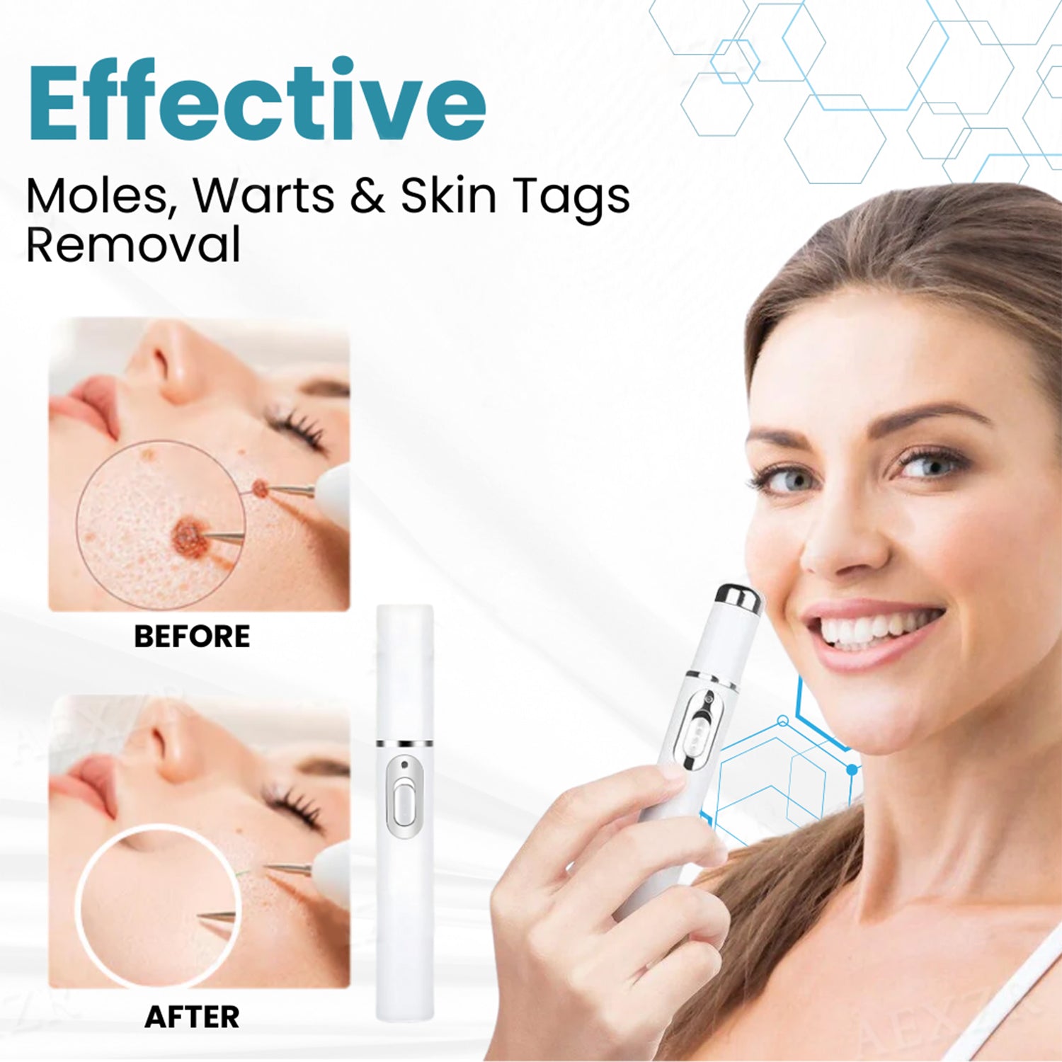 🔥【OFFICIAL STORE】ODEIUN™ Non-Invasive Mole and Wart Removal Laser Pen