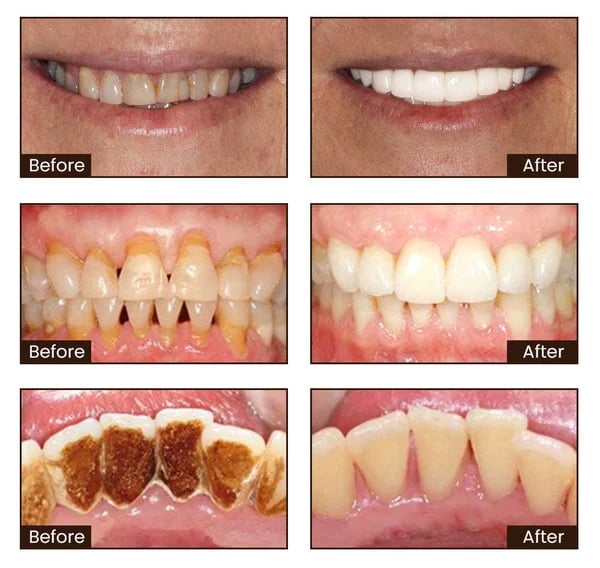 🔥[Official Brand Store] ODALIT™ Niacinamide Intensive Whitening Toothpaste