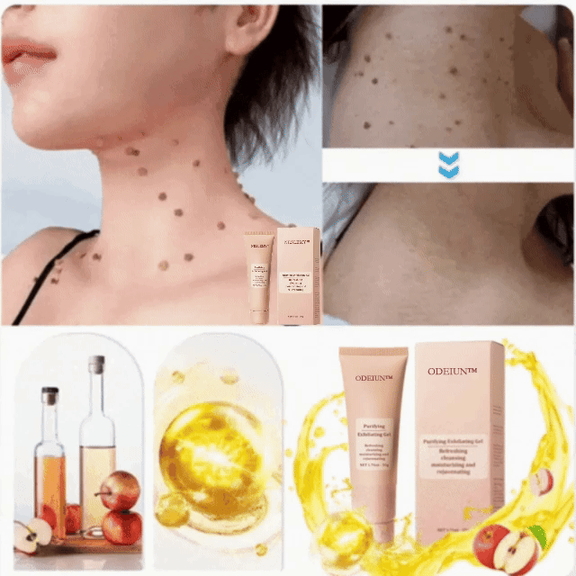 ODEIUN™ Purifying Exfoliating Gel for Acanthosis Nigricans, Exfoliation, Dark Spots, Skin Tags, and Eczema